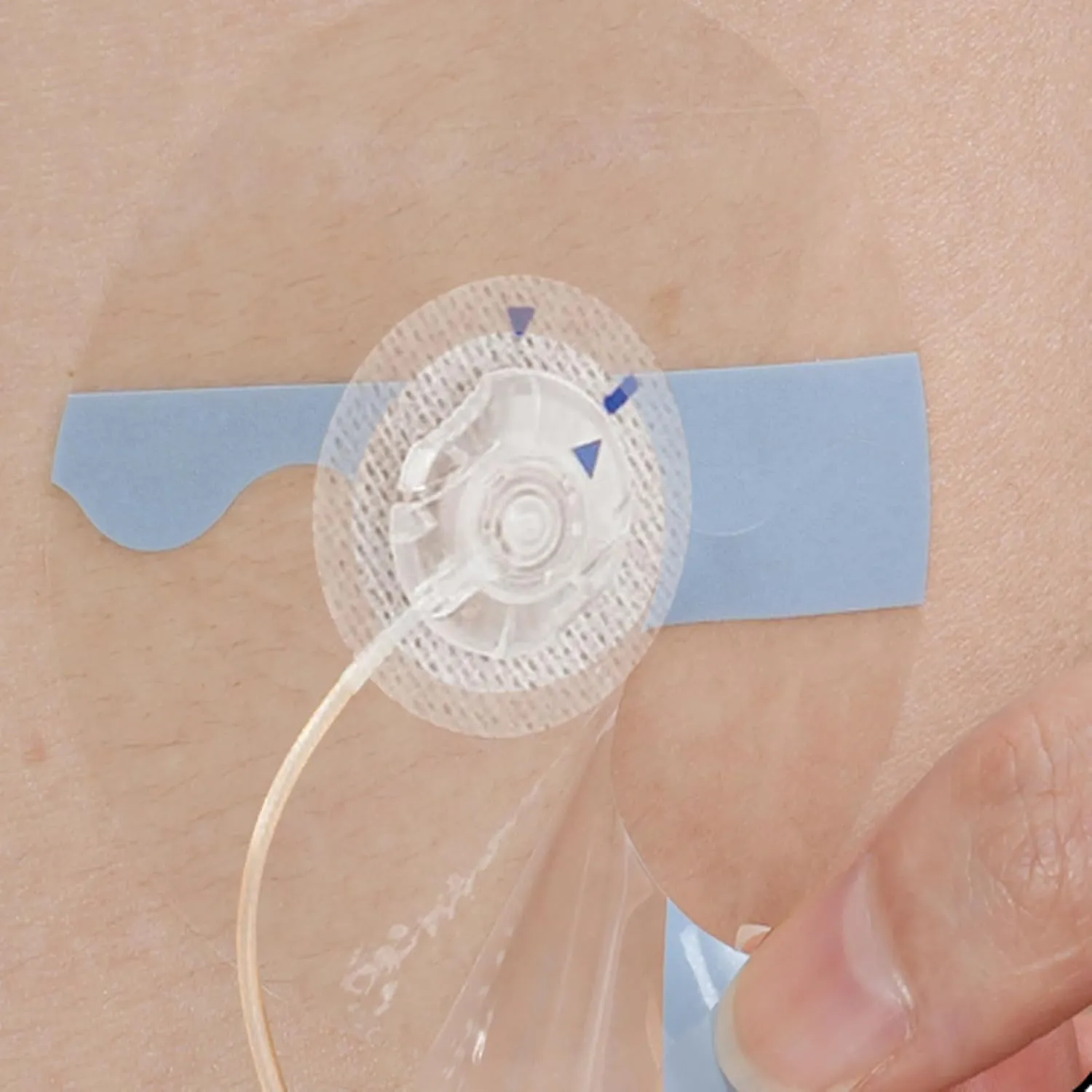 60Pcs Universal Adhesive Patches for CGM and Insulin Pumps, 0.8-Inch Hole, Breathable Clear Patches & Waterproof CGM Sensor Patches 10-14Day, CGM Protection, Pre-Cut Adhesive Tape, Skin-Friendly Patch